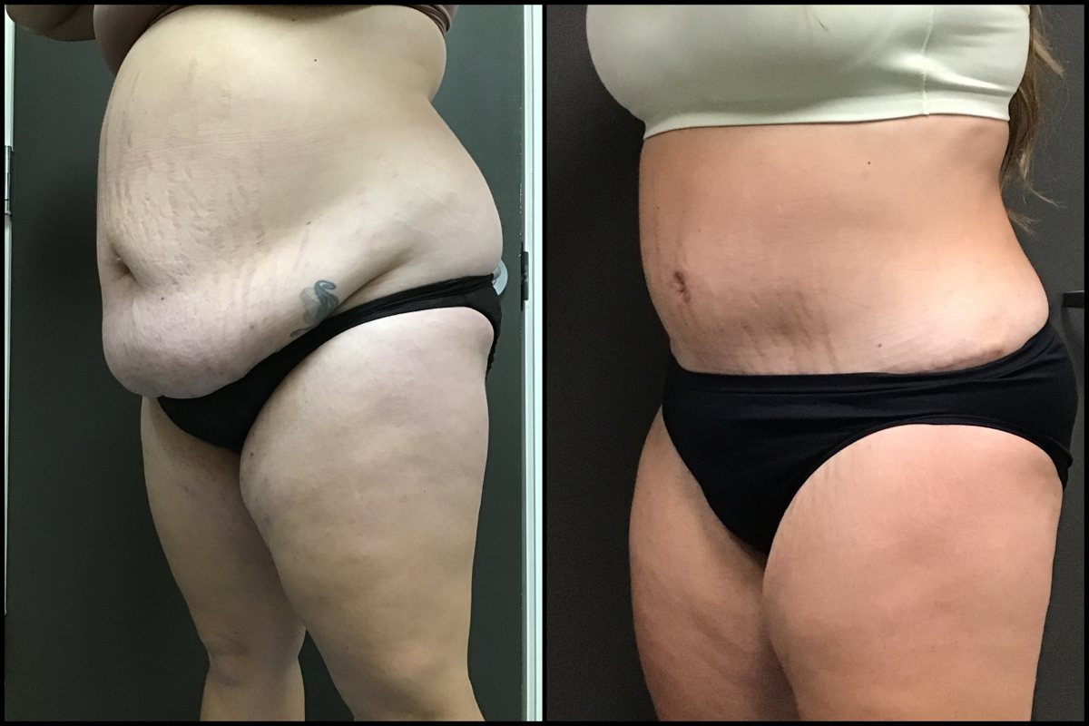 Abdominoplasty – 30 Years Old – 5’7 and 220lbs 4