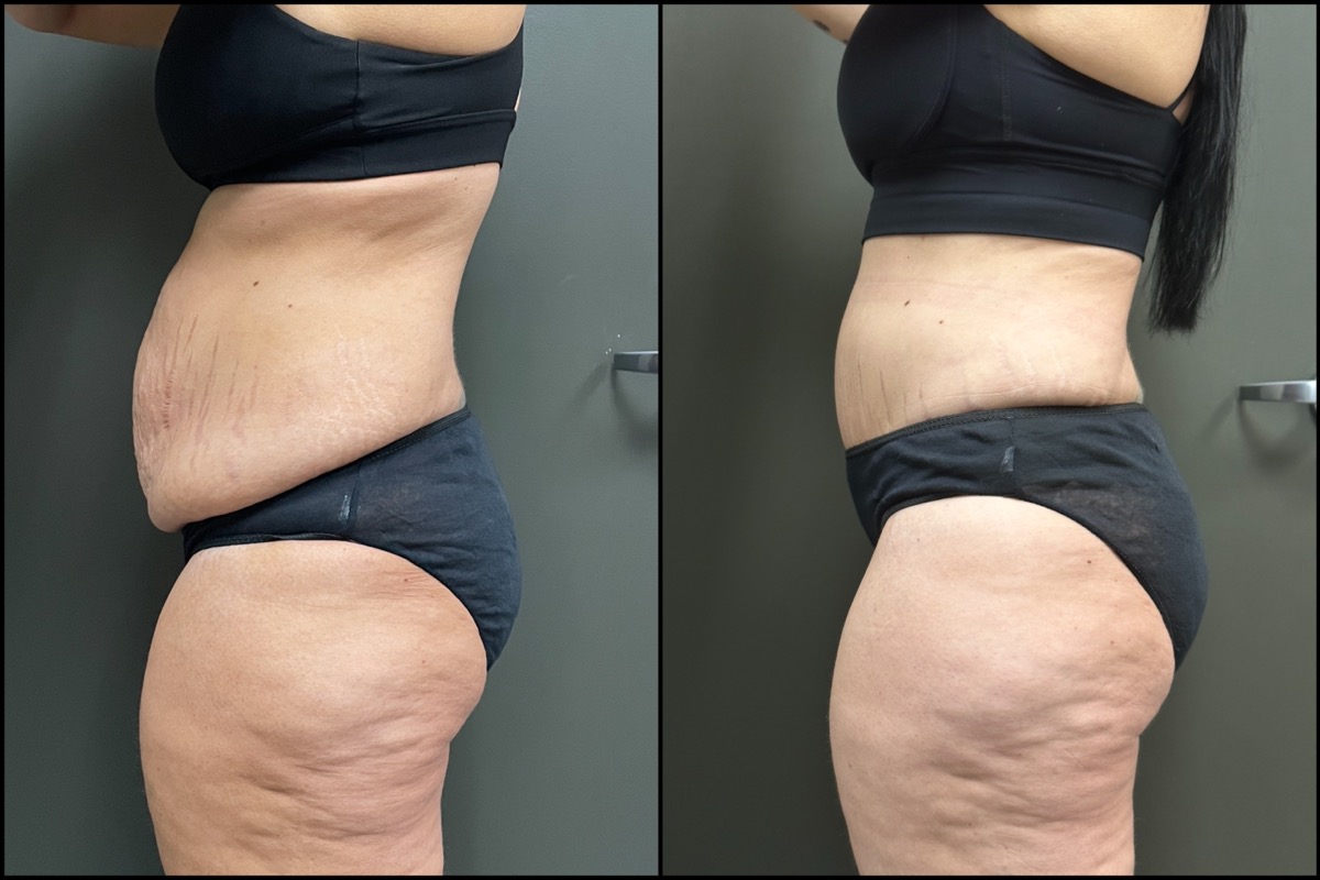 Abdominoplasty - 38 Years Old - 5'4 and 158lbs 4