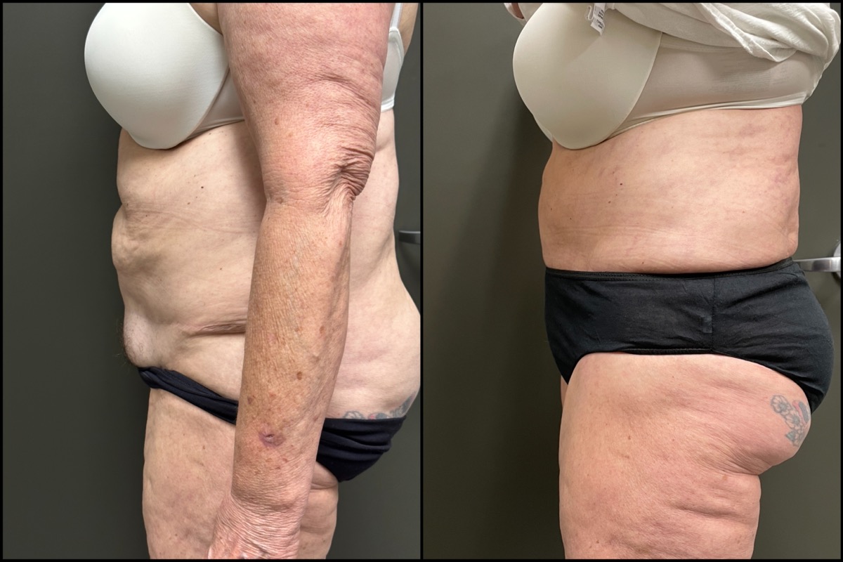 Abdominoplasty - 70 Years Old - 5'8 and 178lbs 4