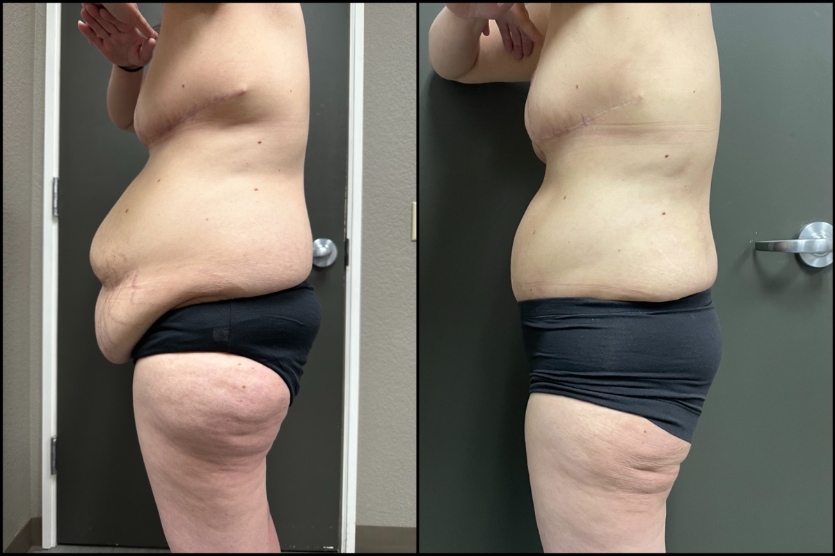 Abdominoplasty & Thigh Liposuction - 45 Years Old - 5'3 and 165lbs 4