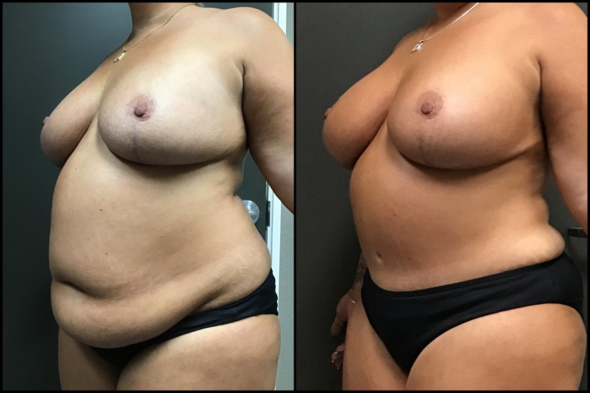 Abdominoplasty & Breast Augmentation with Lift - 42 Years Old - 5'4 and 241lbs #2