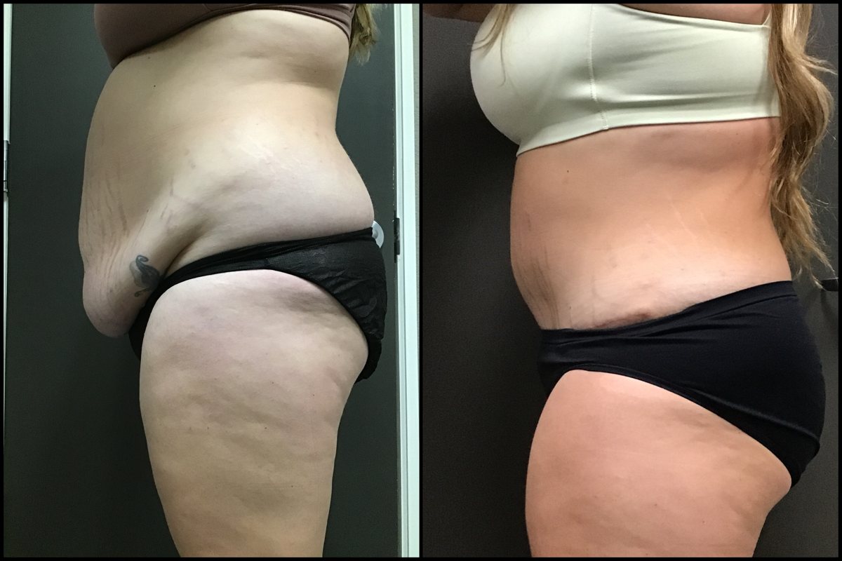 Abdominoplasty – 30 Years Old – 5’7 and 220lbs