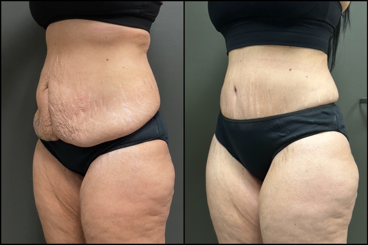 Abdominoplasty - 38 Years Old - 5'4 and 158lbs 5