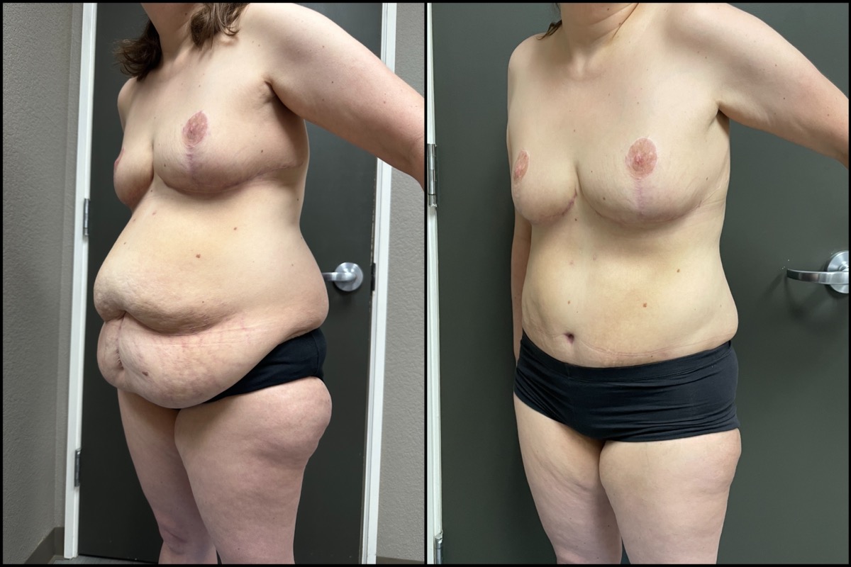 Abdominoplasty & Thigh Liposuction - 45 Years Old - 5'3 and 165lbs 5