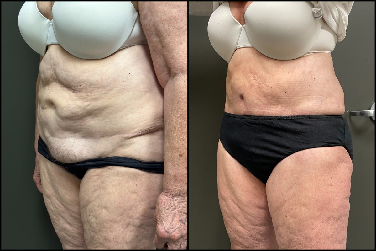 Abdominoplasty - 70 Years Old - 5'8 and 178lbs 5