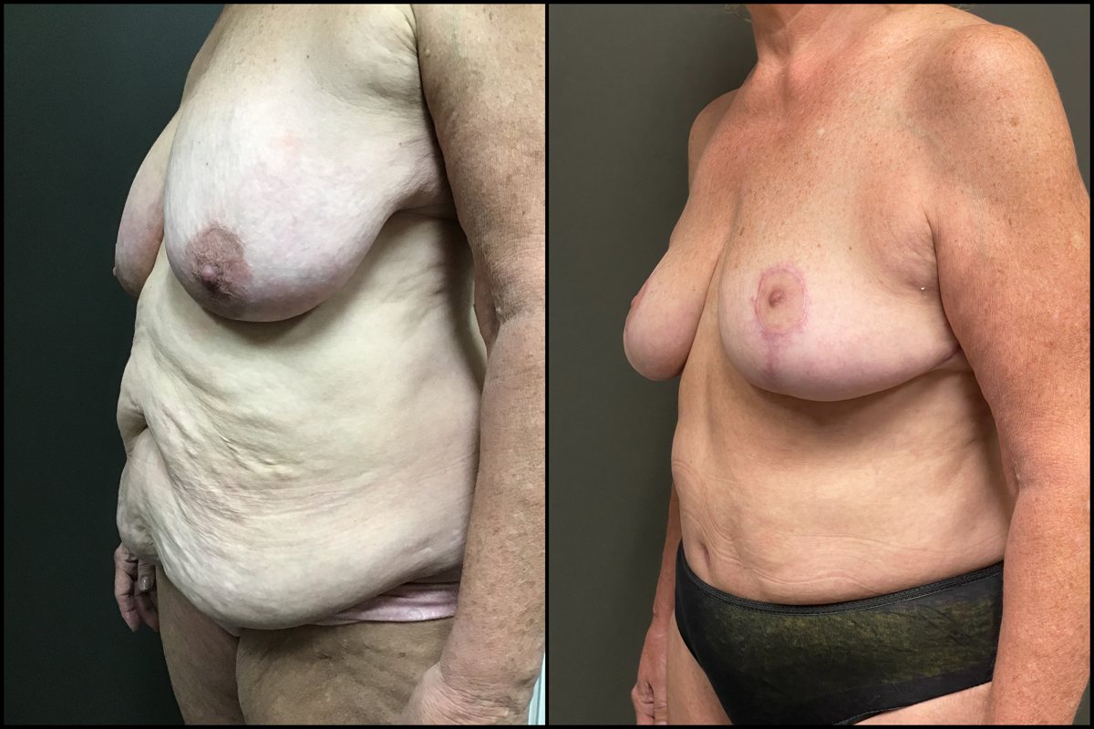 Abdominoplasty & Breast Lift – 59 Years Old – 5’4 and 165lbs #5
