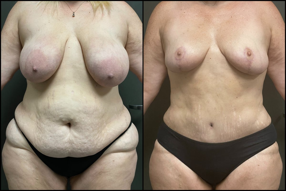 Abdominoplasty, Breast Lift & Lateral Thigh Liposuction – 45 Years Old – 5’5 and 235lbs #1