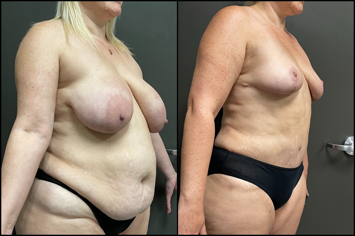 Abdominoplasty, Breast Lift & Lateral Thigh Liposuction – 45 Years Old – 5’5 and 235lbs #2