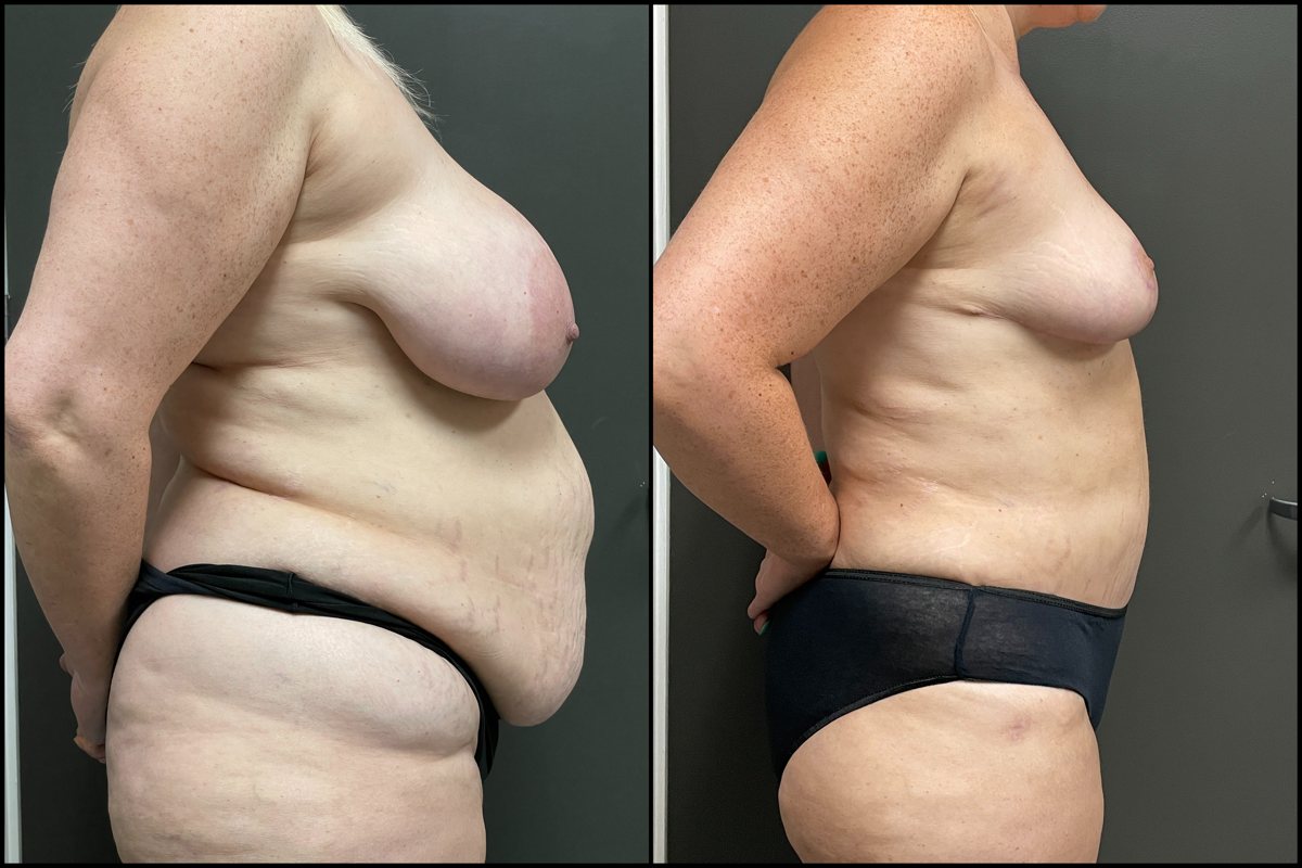 Abdominoplasty, Breast Lift & Lateral Thigh Liposuction – 45 Years Old – 5’5 and 235lbs #3