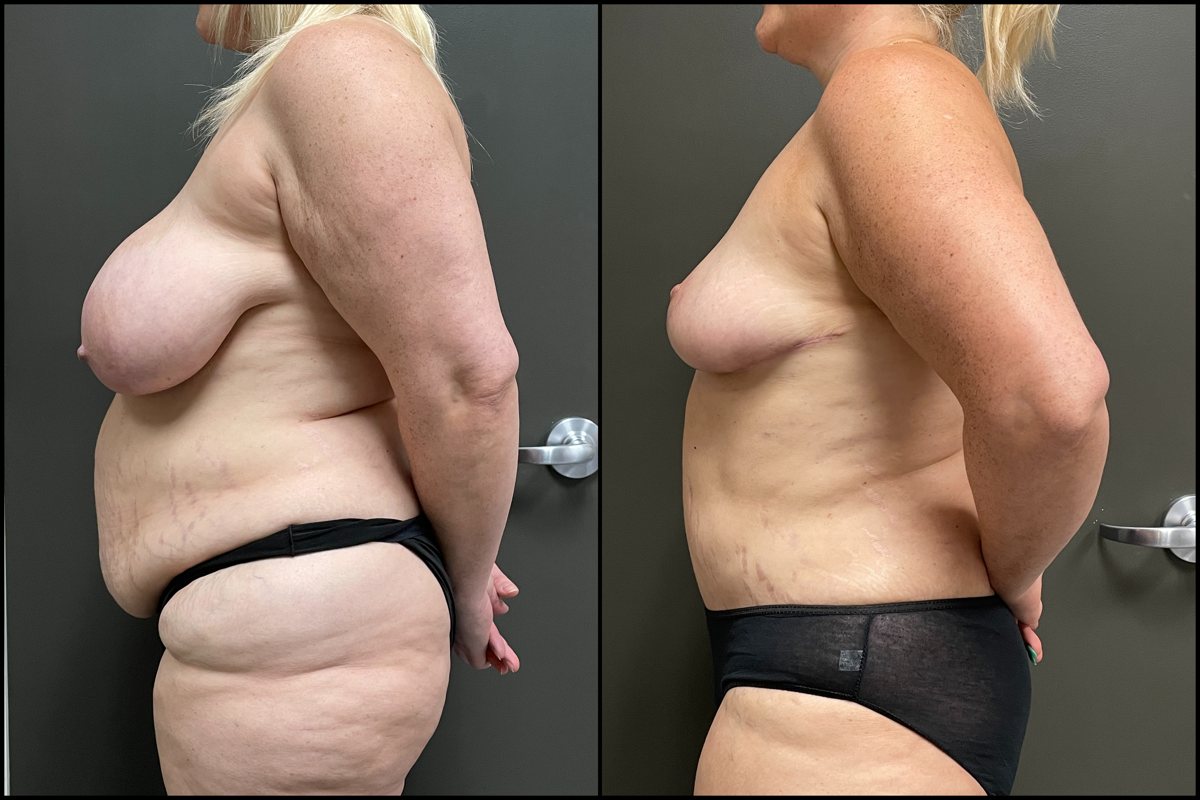 Abdominoplasty, Breast Lift & Lateral Thigh Liposuction – 45 Years Old – 5’5 and 235lbs #4
