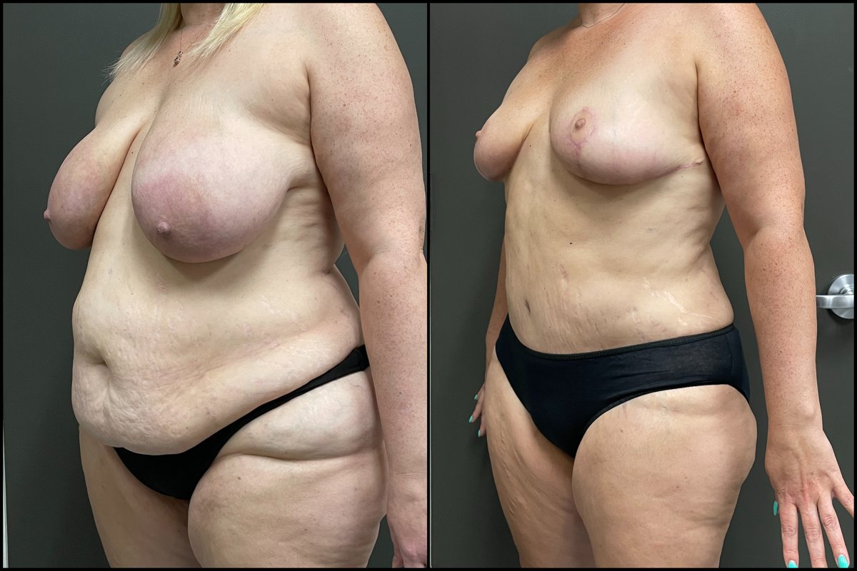Abdominoplasty, Breast Lift & Lateral Thigh Liposuction – 45 Years Old – 5’5 and 235lbs #5