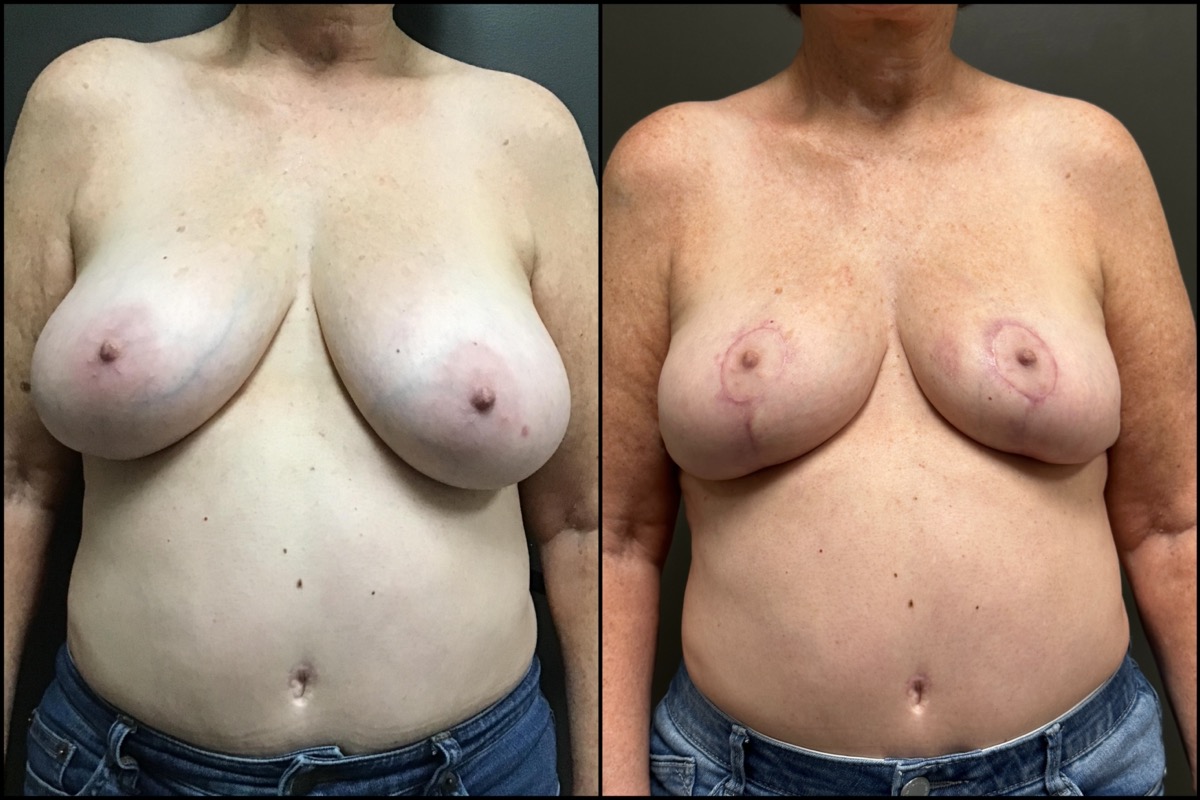 Breast Lift - 68 Years Old - 5'2 and 139lbs 1