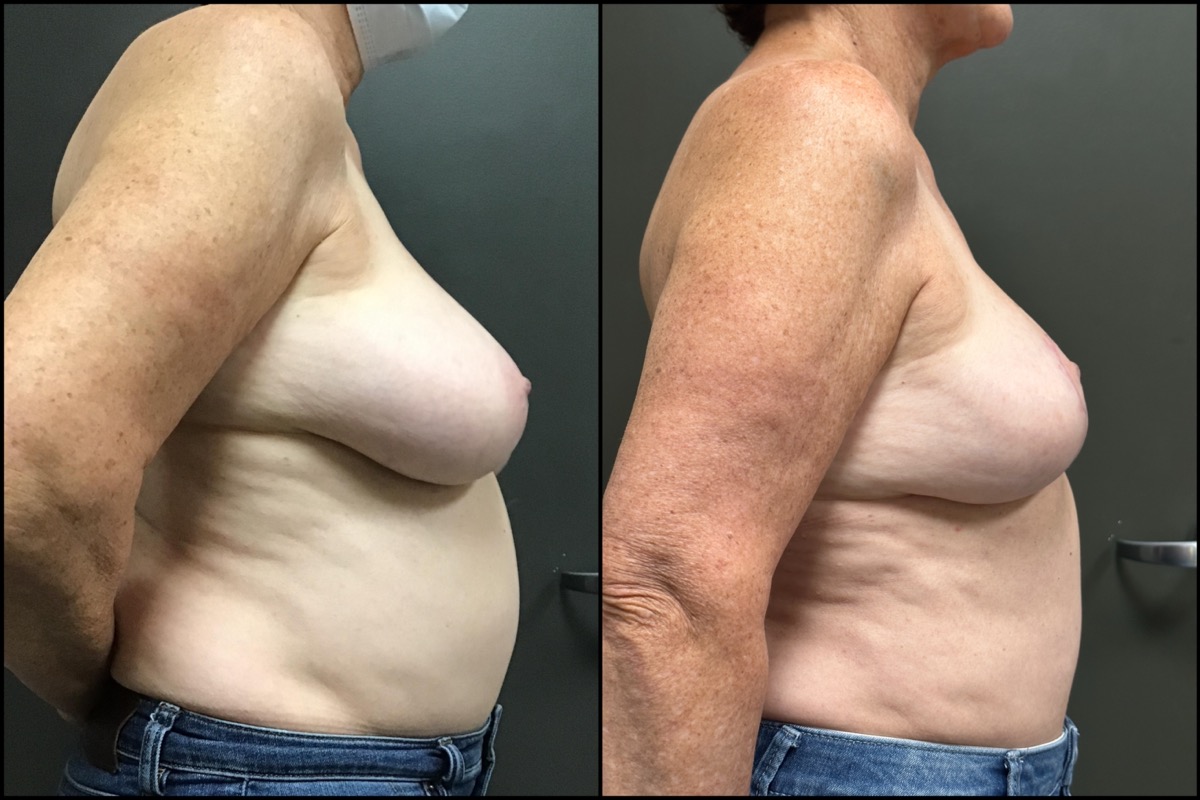 Breast Lift - 68 Years Old - 5'2 and 139lbs 3