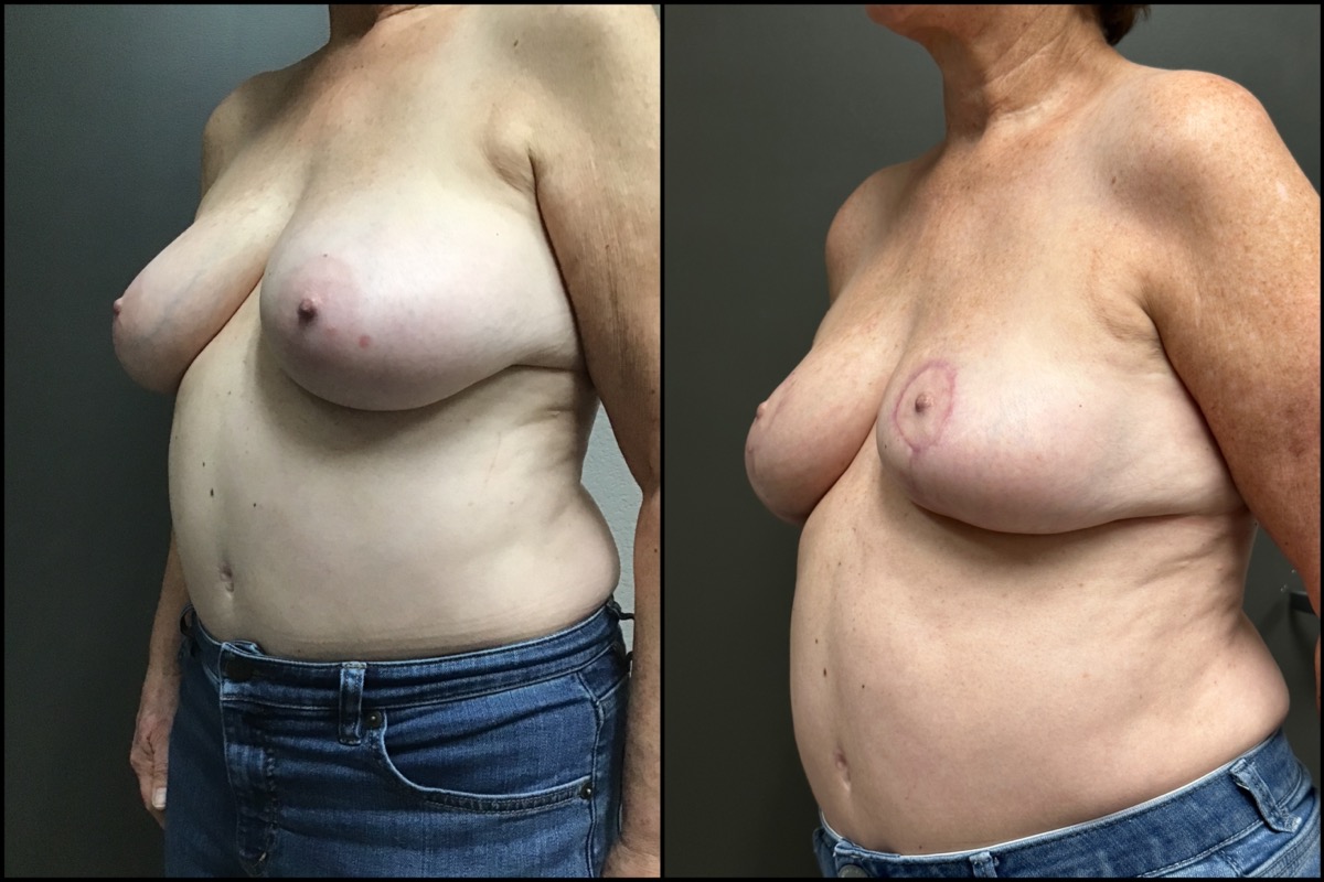 Breast Lift - 68 Years Old - 5'2 and 139lbs 4