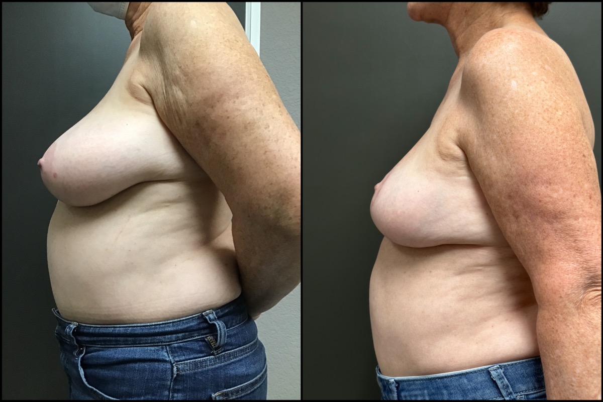 Breast Lift - 68 Years Old - 5'2 and 139lbs 5