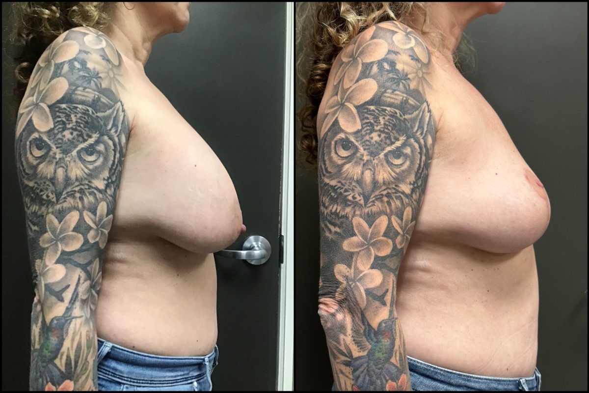 Breast Lift with Implant Removal- 57 Years Old - 5'3 and 128lbs