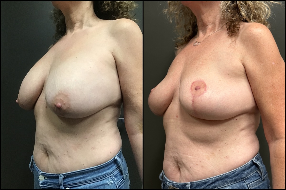 Breast Lift with Implant Removal- 57 Years Old - 5'3 and 128lbs 4
