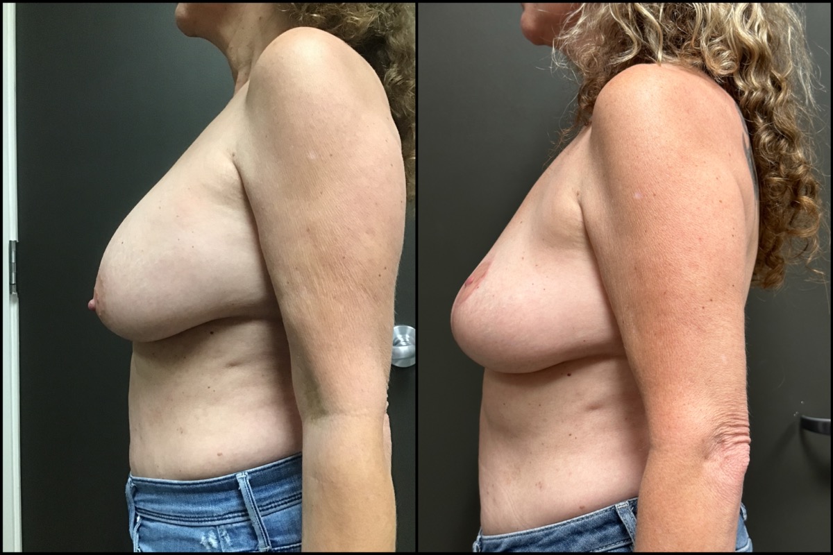 Breast Lift with Implant Removal- 57 Years Old - 5'3 and 128lbs 5