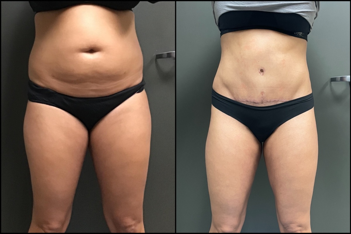 Abdominoplasty - 36 Years Old - 5'4 and 160lbs 1