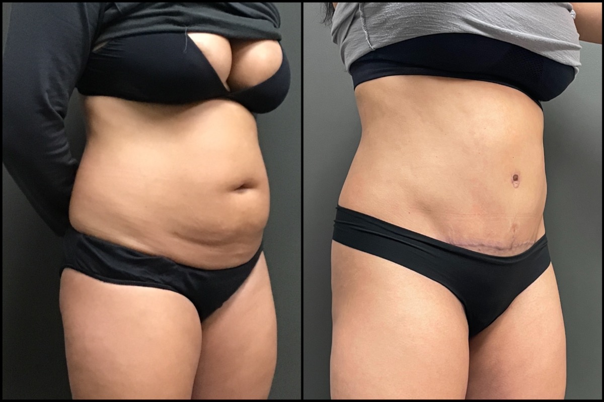 Abdominoplasty - 36 Years Old - 5'4 and 160lbs 2