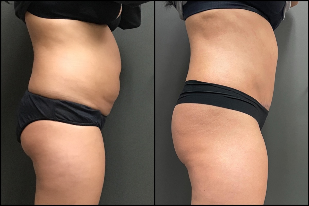 Abdominoplasty - 36 Years Old - 5'4 and 160lbs 3
