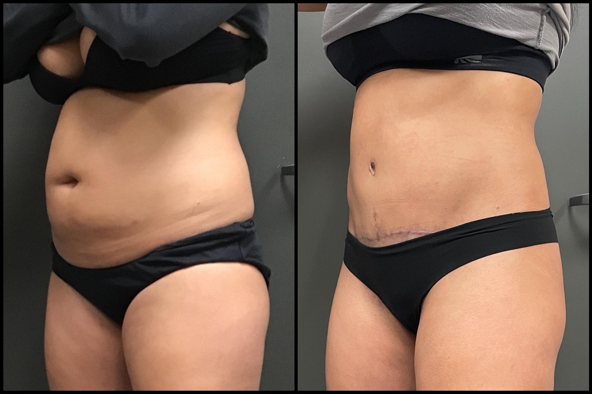 Abdominoplasty - 36 Years Old - 5'4 and 160lbs 4