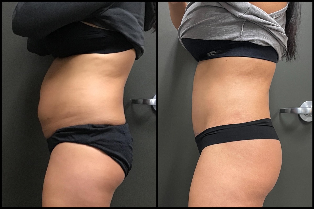 Abdominoplasty - 36 Years Old - 5'4 and 160lbs 5