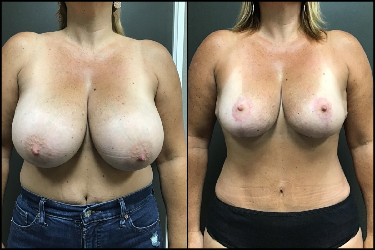 Breast Reduction & Mini Abdominoplasty – G cup to DD cup – 47 Years Old 1