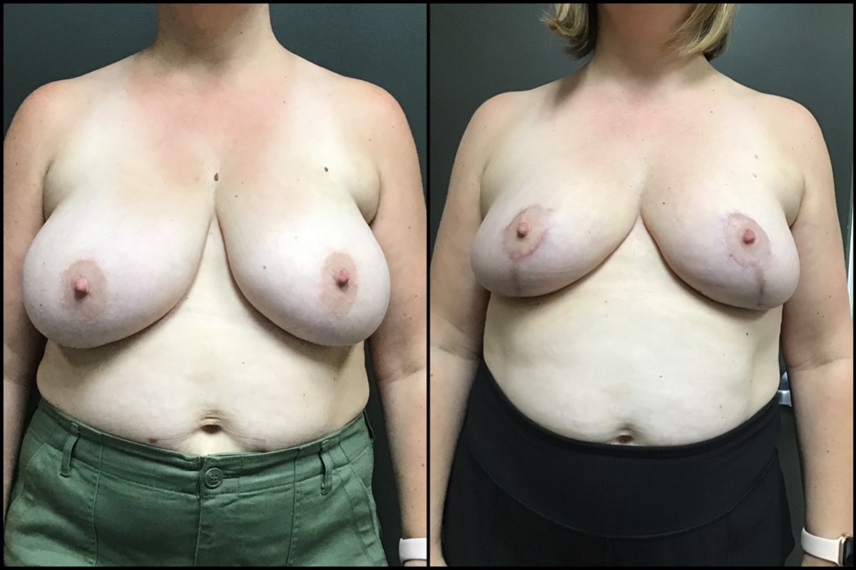 Breast Reduction - G cup to C cup - 42 Years Old 1