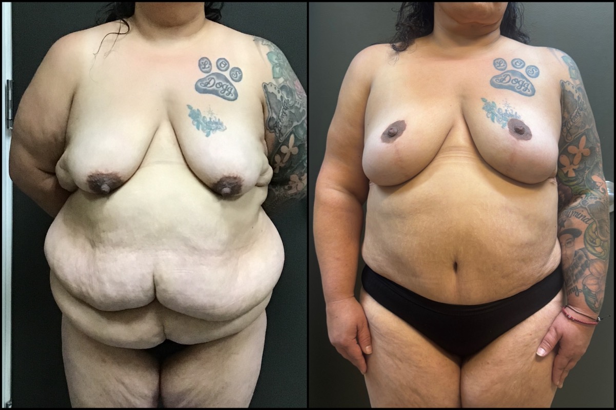 Breast Lift & Abdominoplasty - 41 Years Old - 5'1 and 230 lbs. 1