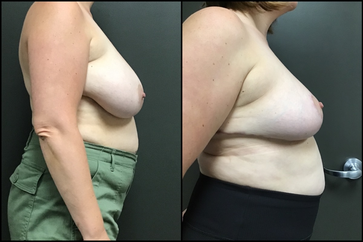 Breast Reduction - G cup to C cup - 42 Years Old 2