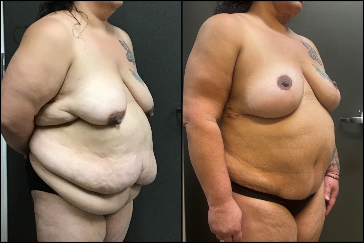 Breast Lift & Abdominoplasty - 41 Years Old - 5'1 and 230 lbs. 2