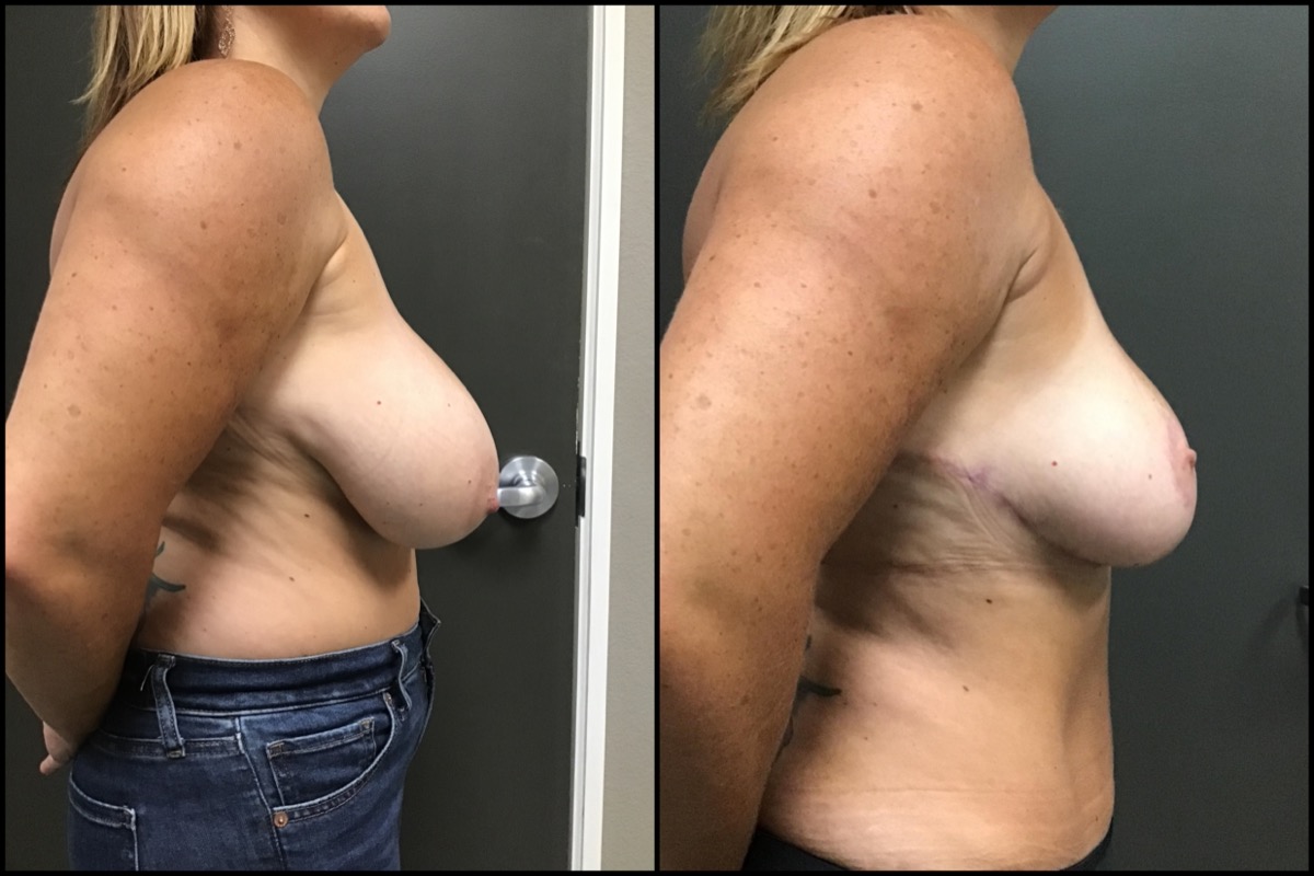 Breast Reduction & Mini Abdominoplasty – G cup to DD cup – 47 Years Old 3