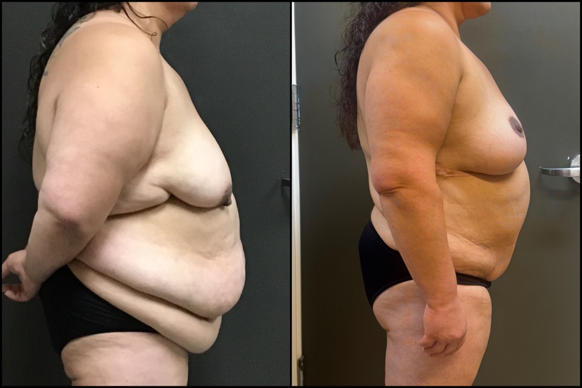 Breast Lift & Abdominoplasty - 41 Years Old - 5'1 and 230 lbs. 3