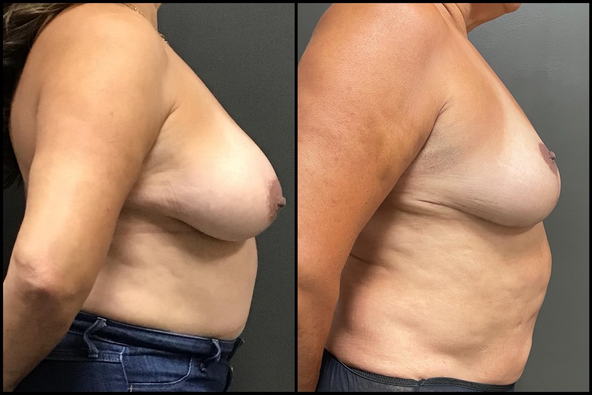 Breast Reduction – DD cup to C cup – 56 Years Old 3