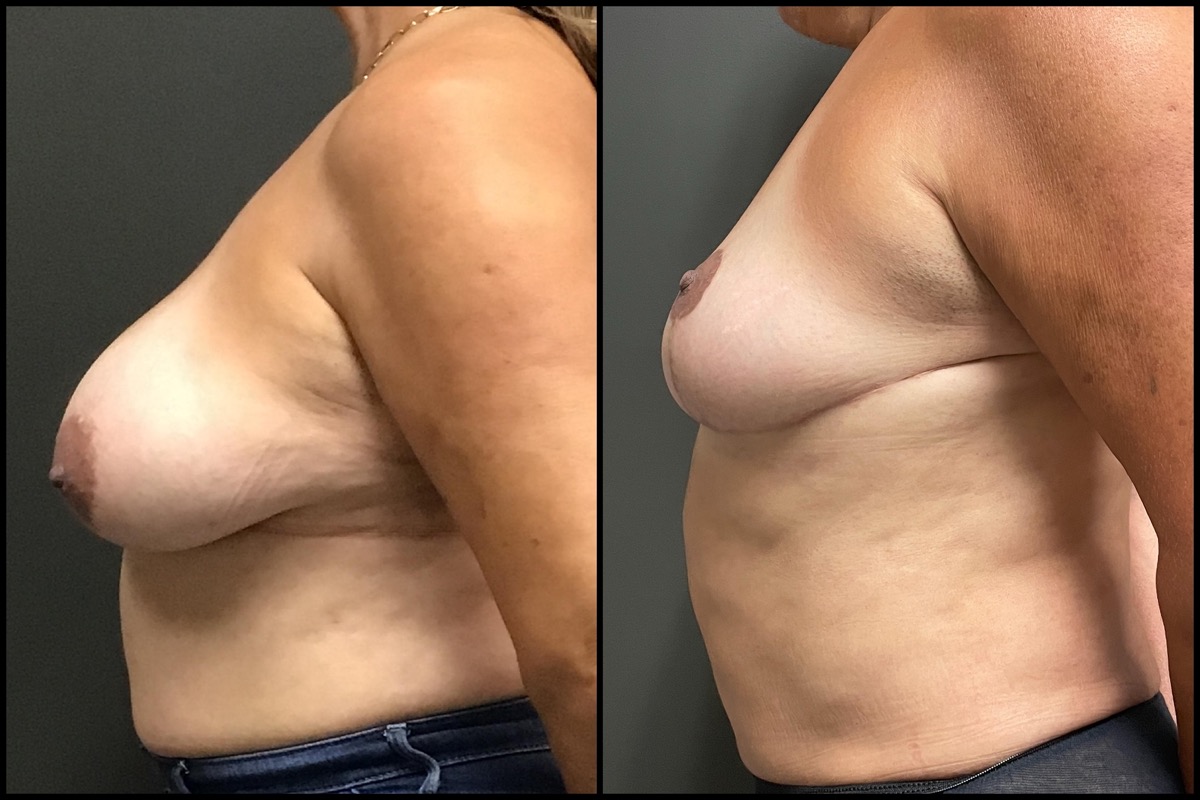 Breast Reduction – DD cup to C cup – 56 Years Old 4