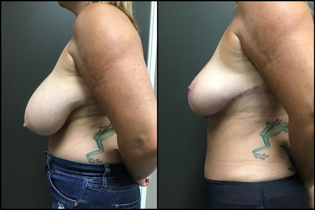 Breast Reduction & Mini Abdominoplasty – G cup to DD cup – 47 Years Old 5