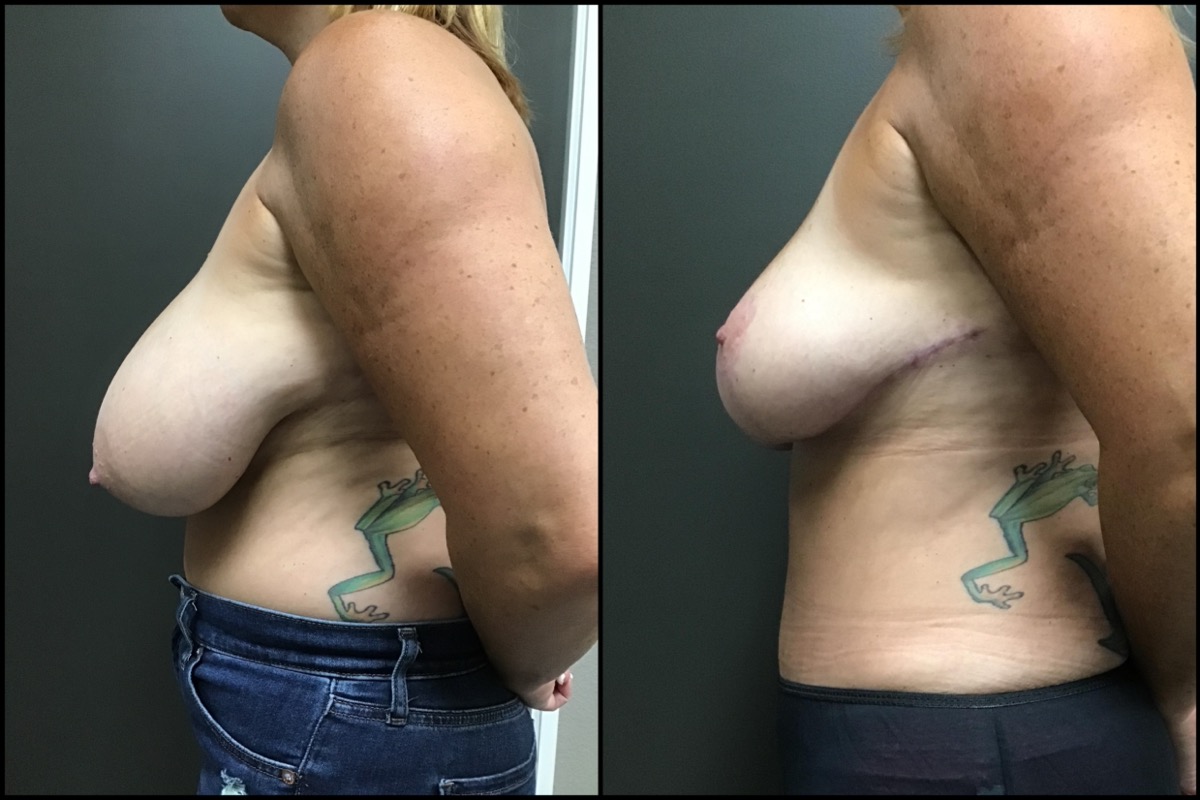 Breast Reduction Before & After Photos