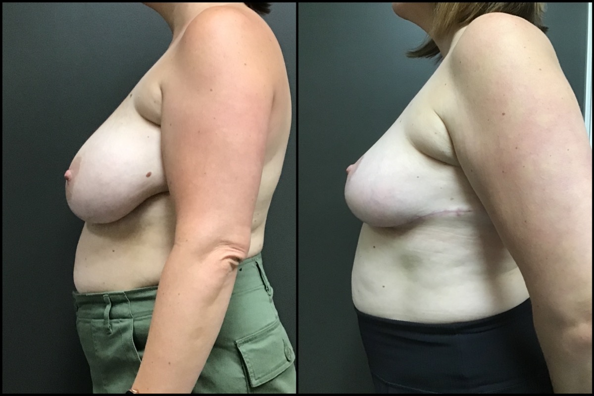 Breast Reduction - G cup to C cup - 42 Years Old 5