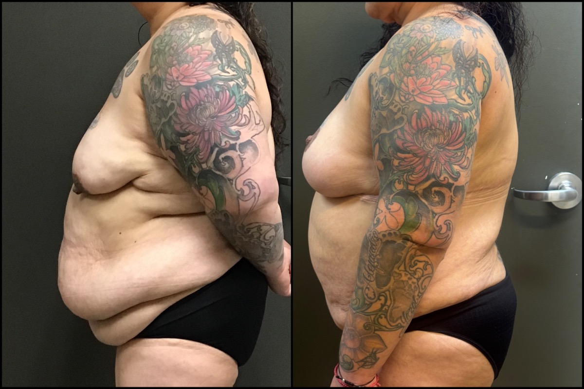 Breast Lift & Abdominoplasty - 41 Years Old - 5'1 and 230 lbs. 5