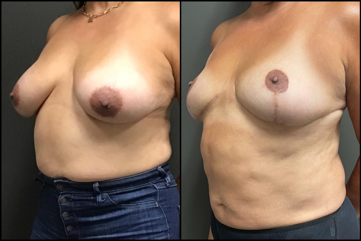 Breast Reduction – DD cup to C cup – 56 Years Old 5