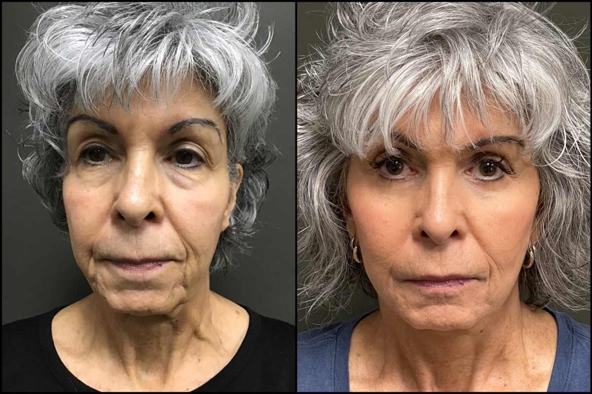 Lower Blepharoplasty - 69 Years Old 1