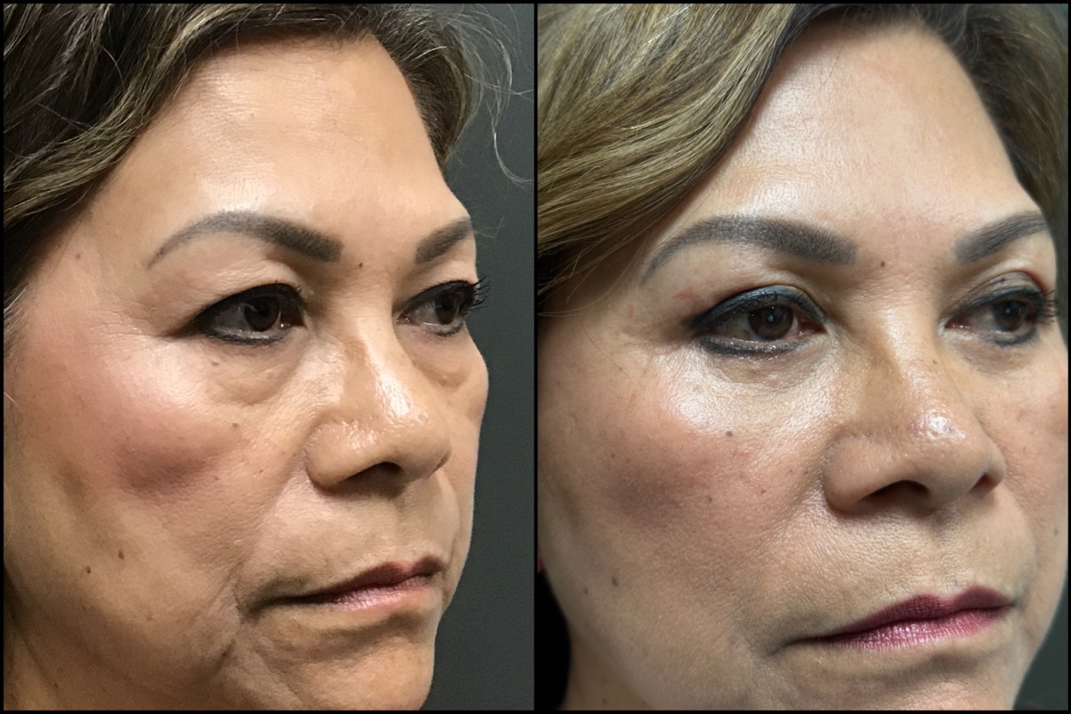 Mini Facelift with Upper & Lower Blepharoplasty - 61 Years Old 2