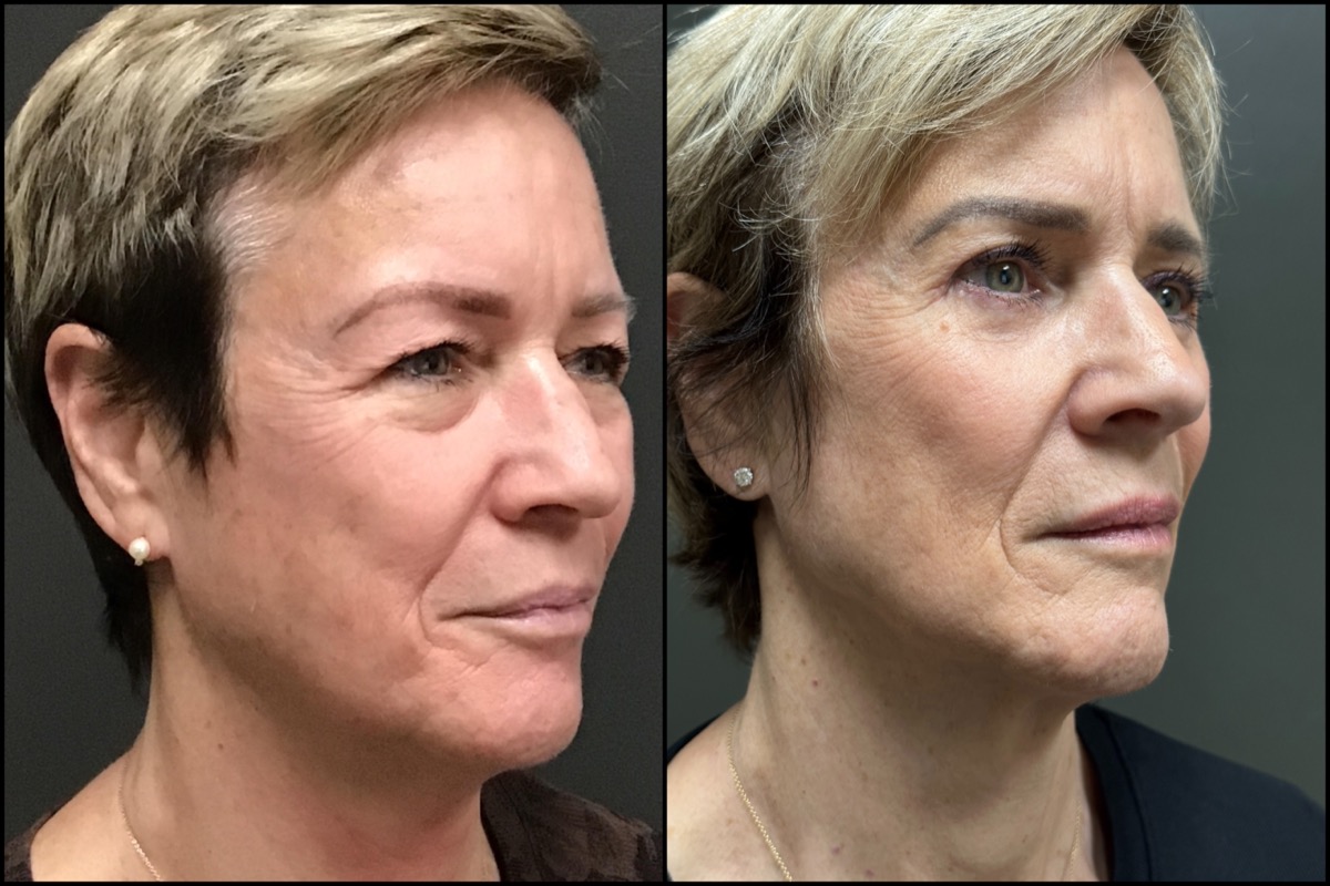 Upper and Lower Blepharoplasty - 65 Years Old 2