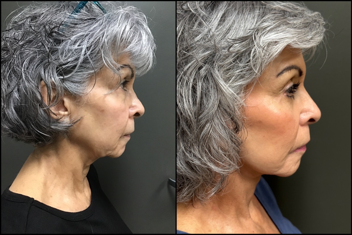 Lower Blepharoplasty - 69 Years Old 3