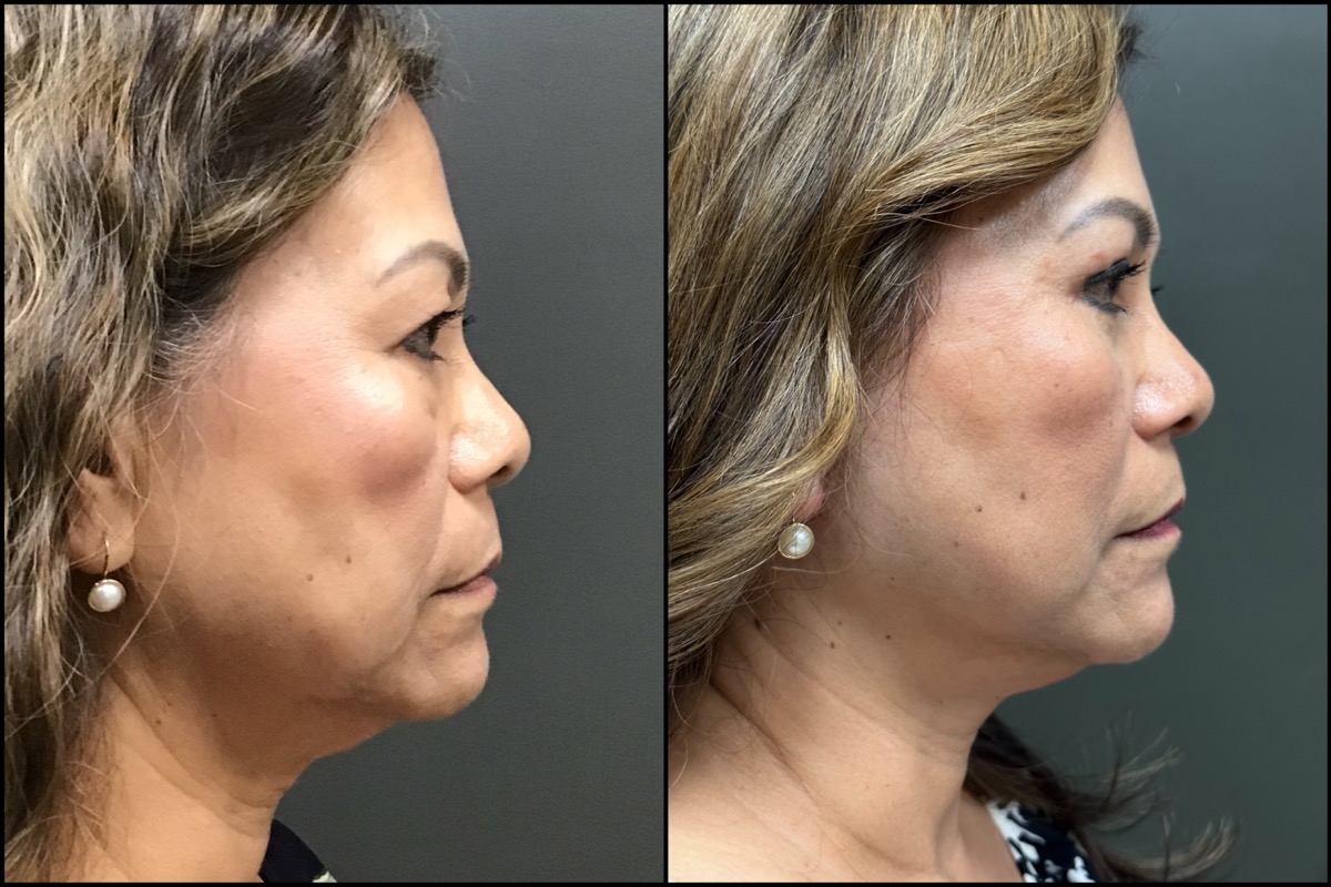 Mini Facelift with Upper & Lower Blepharoplasty - 61 Years Old 3