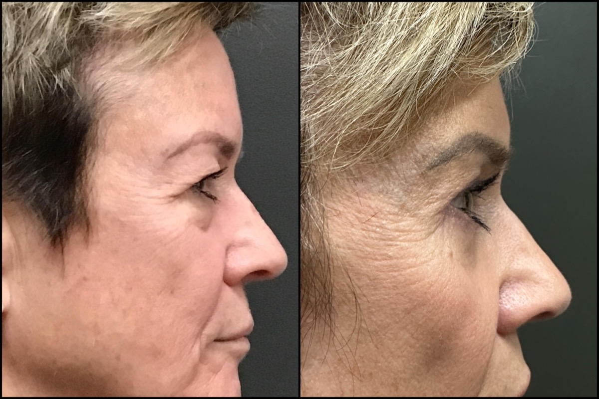 Upper and Lower Blepharoplasty - 65 Years Old 3