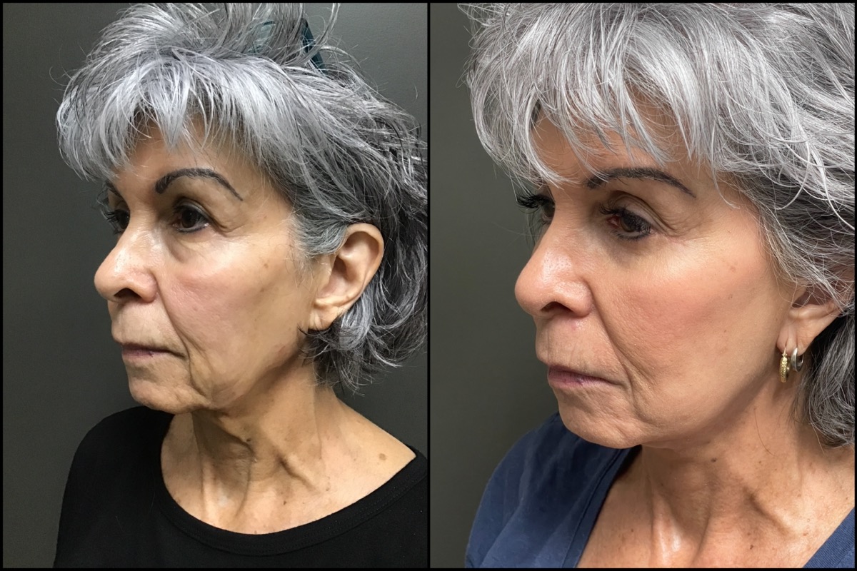 Lower Blepharoplasty - 69 Years Old 4