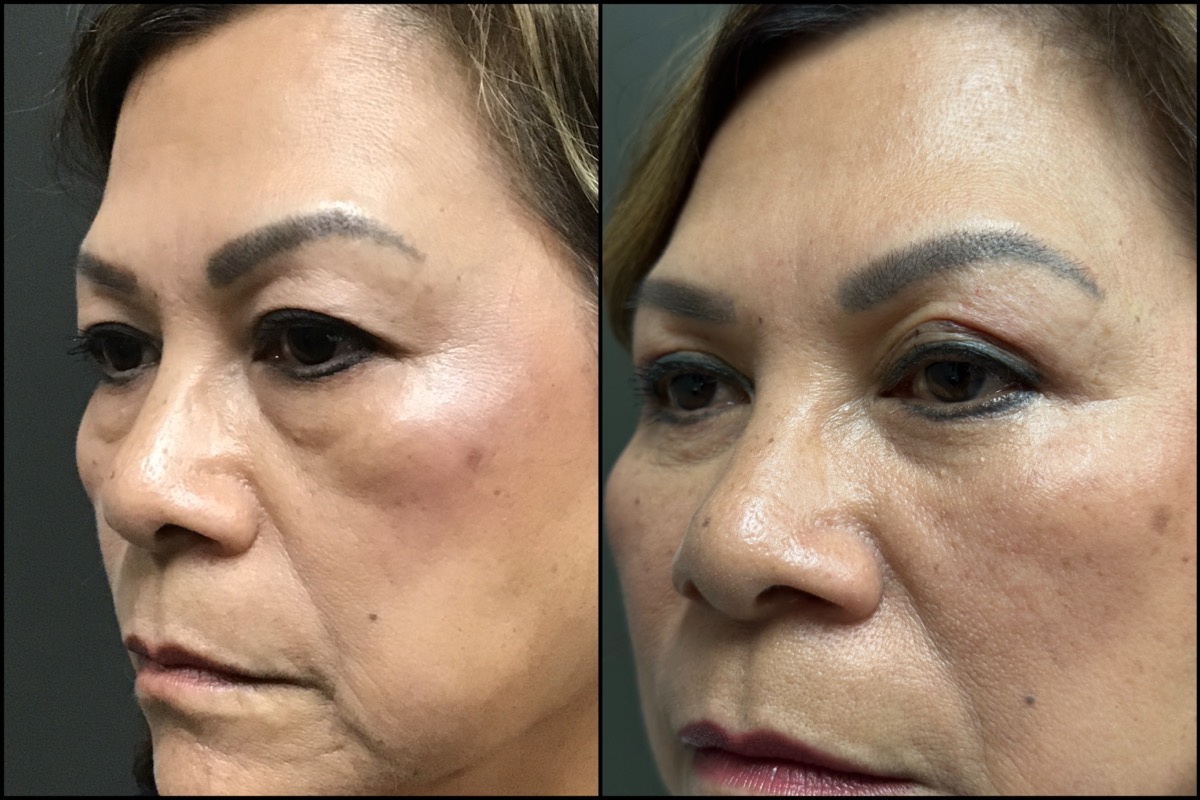 Upper and Lower Blepharoplasty - 61 Years Old 4