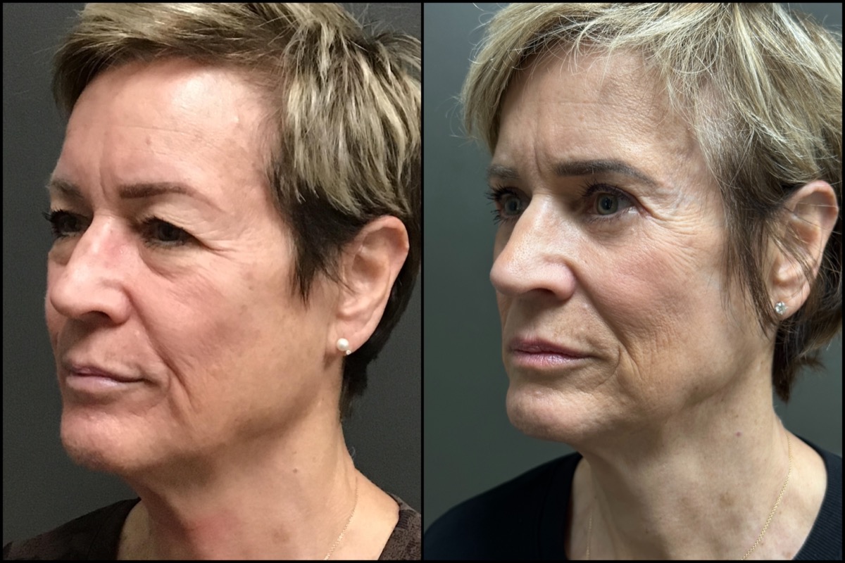 Upper and Lower Blepharoplasty - 65 Years Old 4